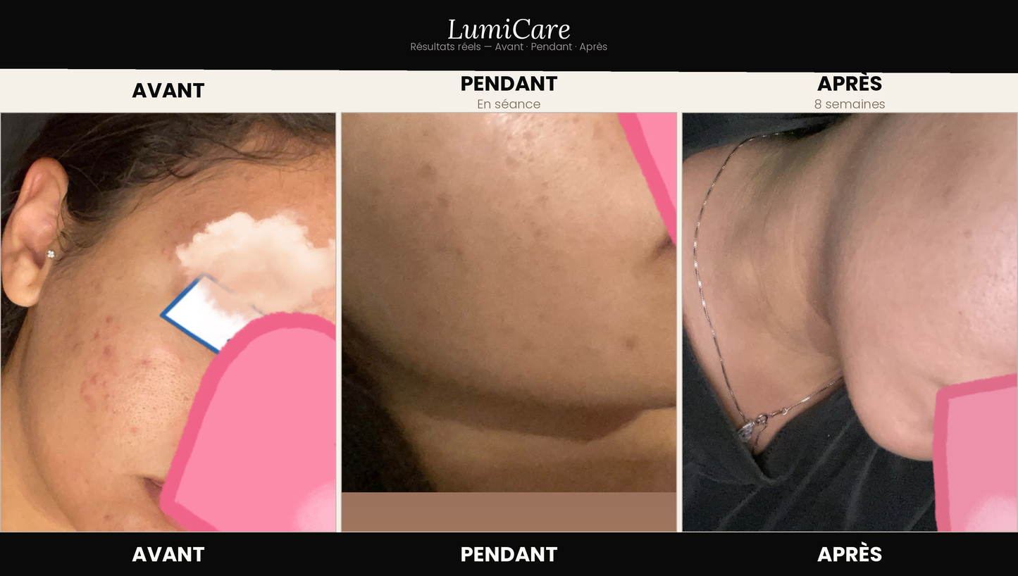 Masque LED LumiCare